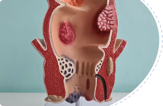 Anal Fissure Nonsurgical treatments