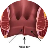 Anal Fissure