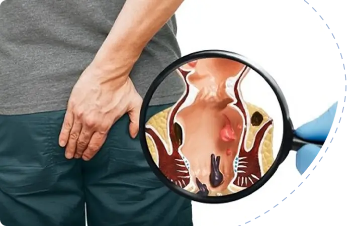Anal Fistula Recovery and postoperative self-care