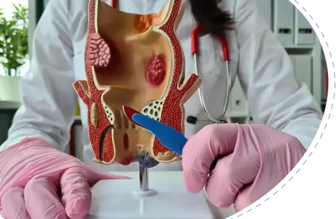 Anal Fistula treatment & management