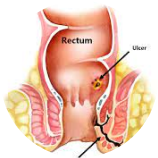 Anal Fistula