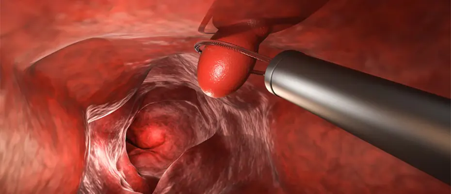 Anal Skin Tag treatment