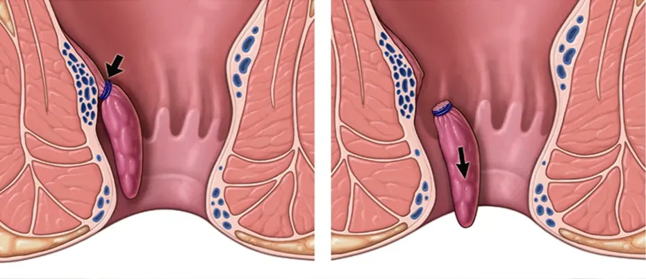 Anal Skin Tags: Symptoms, causes and treatment in Bangladesh
