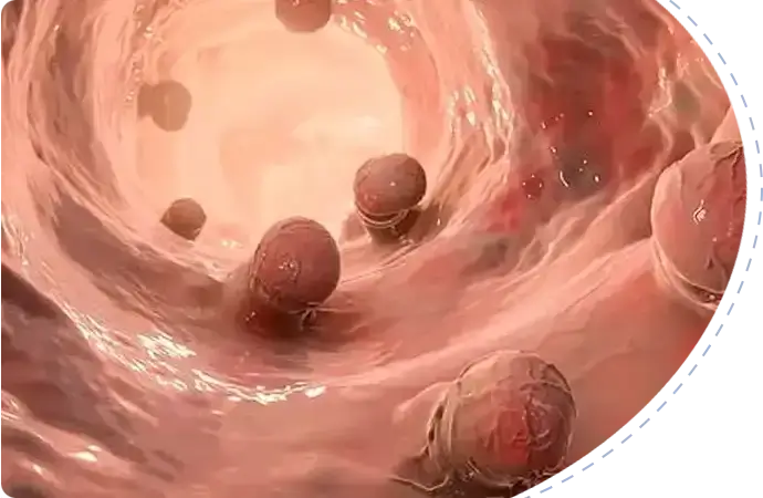 Causes and risk factors of villous adenomas