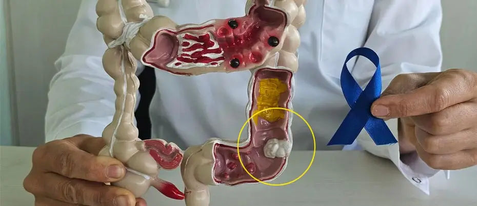 কোলন ক্যান্সার কারণ এবং ঝুঁকি