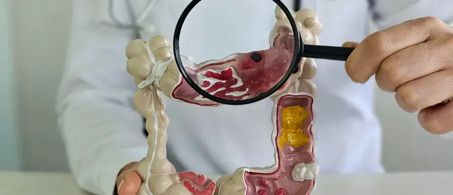 Colon Cancer Symptoms Guideline for Bangladeshi patients