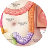 Colon Cancer