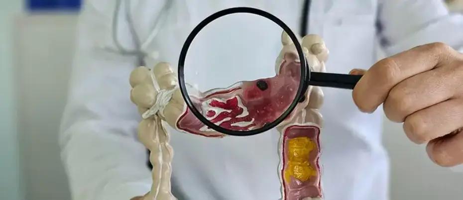 Colorectal cancer: Signs, symptoms, and causes