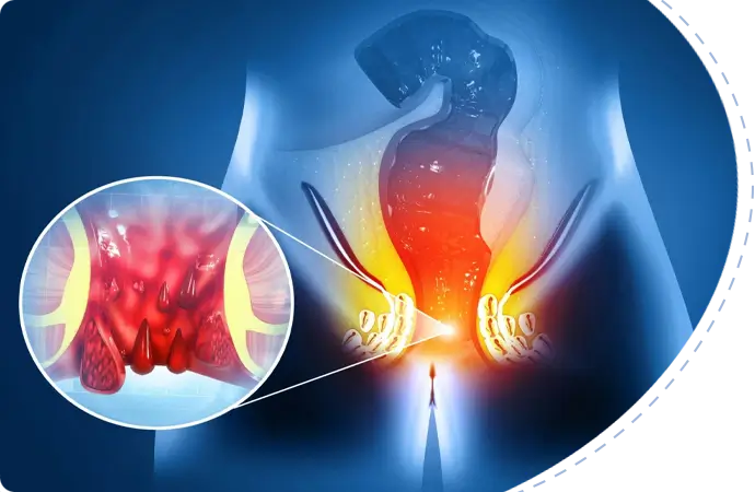 Colorectal laser surgery cost in Bangladesh
