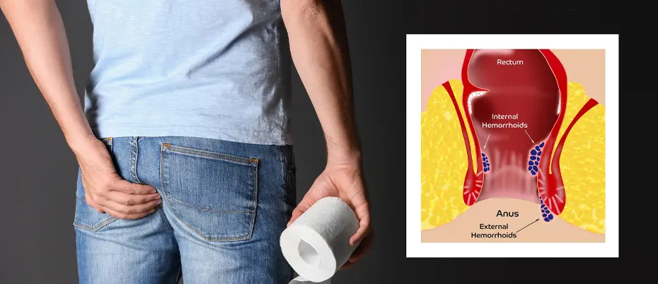 Common causes of rectal pain
