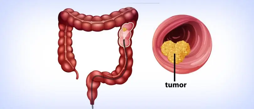 Common signs & symptoms of rectal cancer