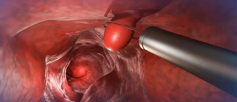 Diagnosis of rectal bleeding in Bangladesh