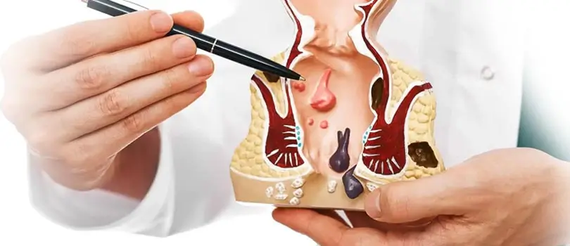 Eligibility stapled hemorrhoidectomy piles treatment
