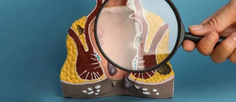 How to treat anal fistula permanently