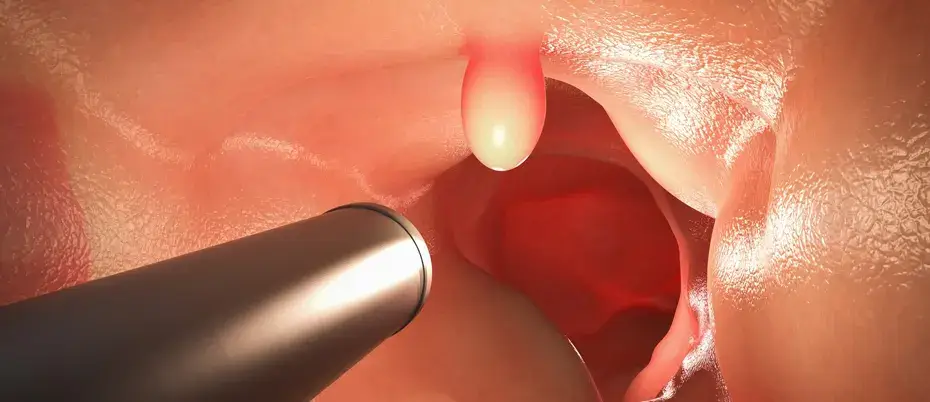 laser piles treatment work process