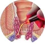 LASER Treatment