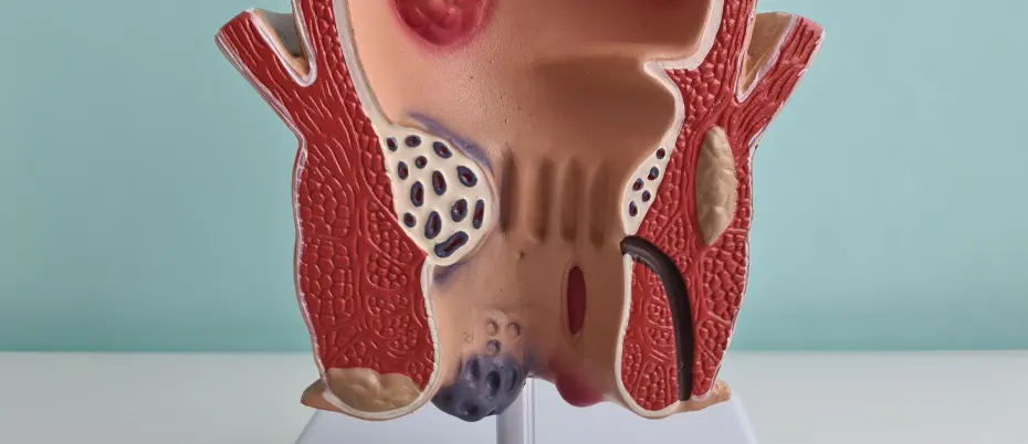 Symptoms of colorectal diseases in Bangladesh