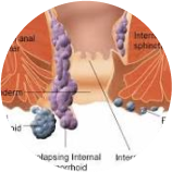 Piles or Hemorrhoid