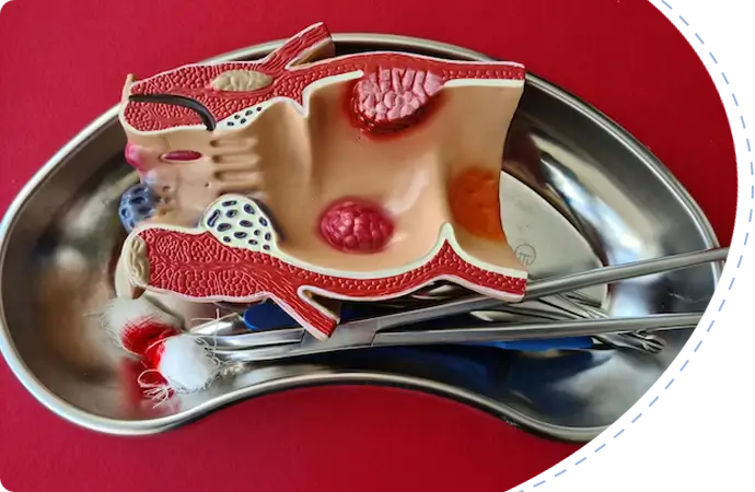 Pilonidal cyst and sinus Symptoms