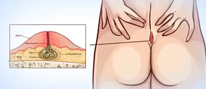 Pilonidal Sinus surgery cost in Bangladesh