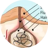 Pilonidal Sinus