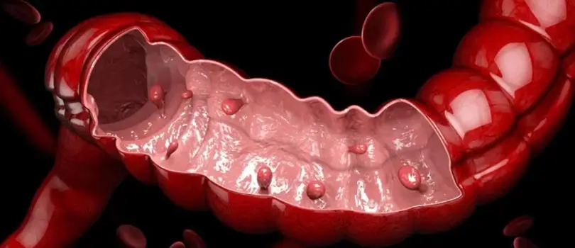 Rectal cancer signs and symptoms Bangladesh