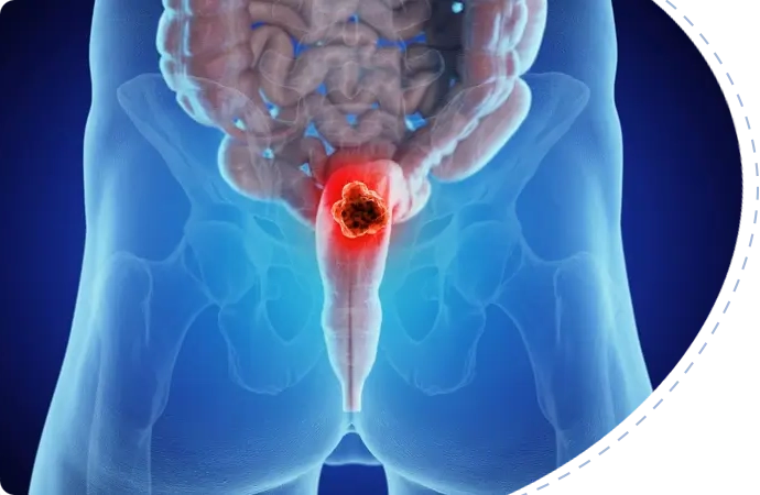 Rectal Cancer symptoms