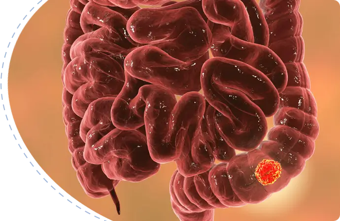 Rectal Cancer treatment in Bangladesh
