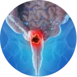 Rectal Cancer