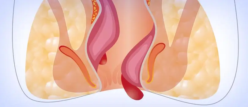 Rubber band ligation benefits