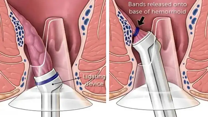 Rubber Band Ligation for Hemorrhoids in Bangladesh