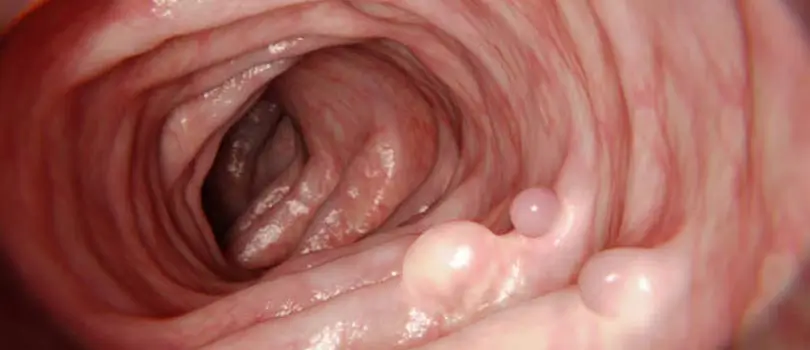 Signs of colorectal polyps and when to get screened