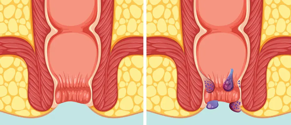 Symptoms of Anal Skin Tags
