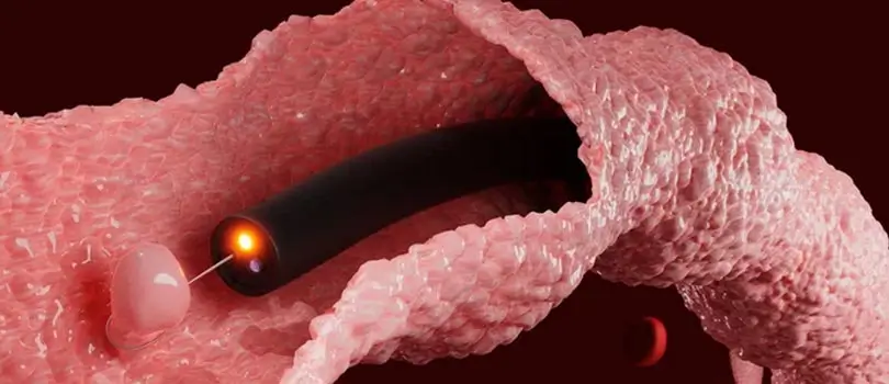 The risk factors of colorectal polyps?