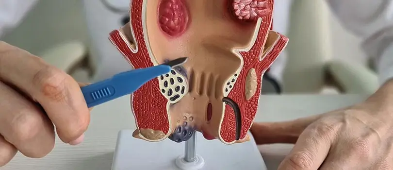 অ্যাানাল ফিস্টুলার চিকিৎসা