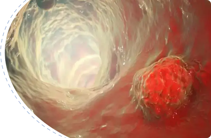 Villous adenoma treatment in Bangladesh