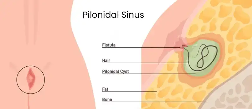 What is a pilonidal sinus?