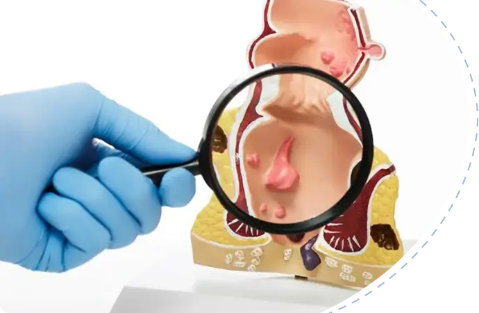 What is radiation proctitis?