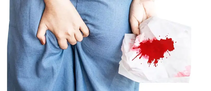 When to see a doctor for treatment of proctitis?