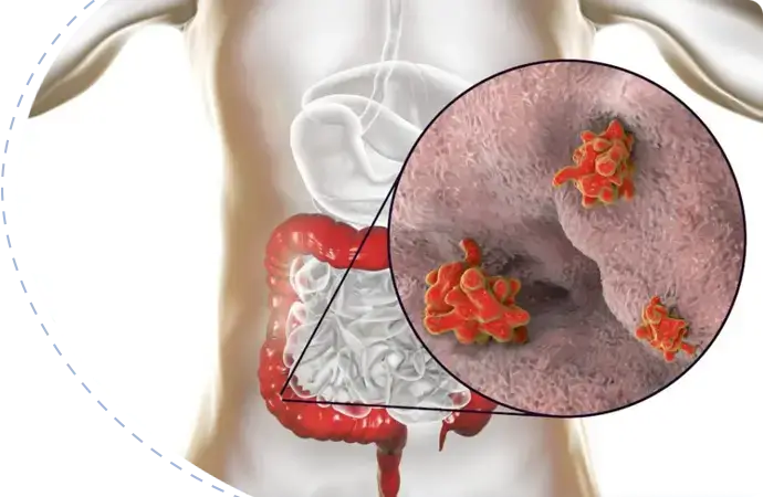 Why choose Prof. Dr. Tariq Akhtar Khan for villous adenoma treatment?
